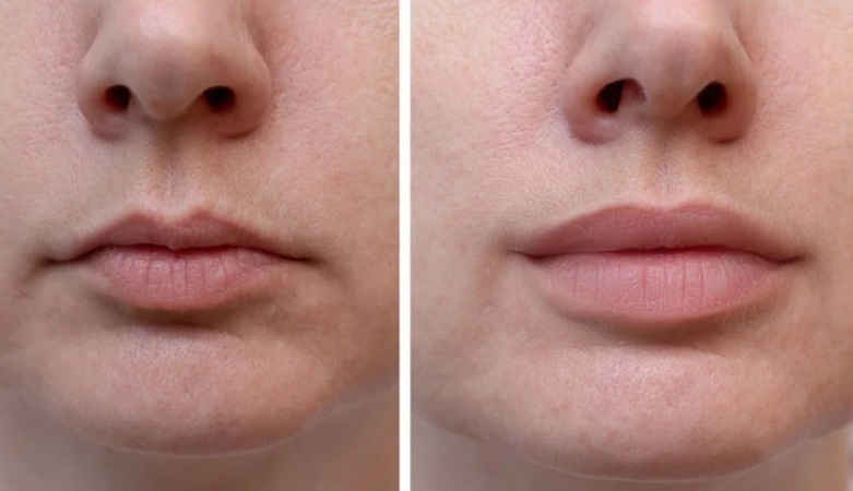 lip-augmentation-market