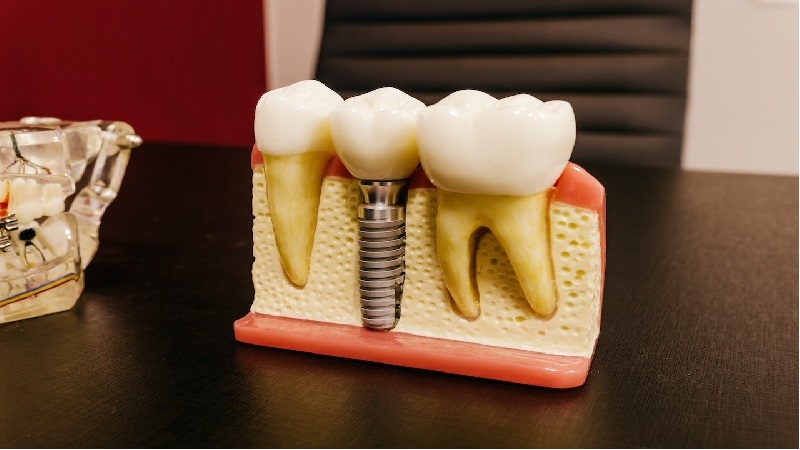 peek-dental-implants-market