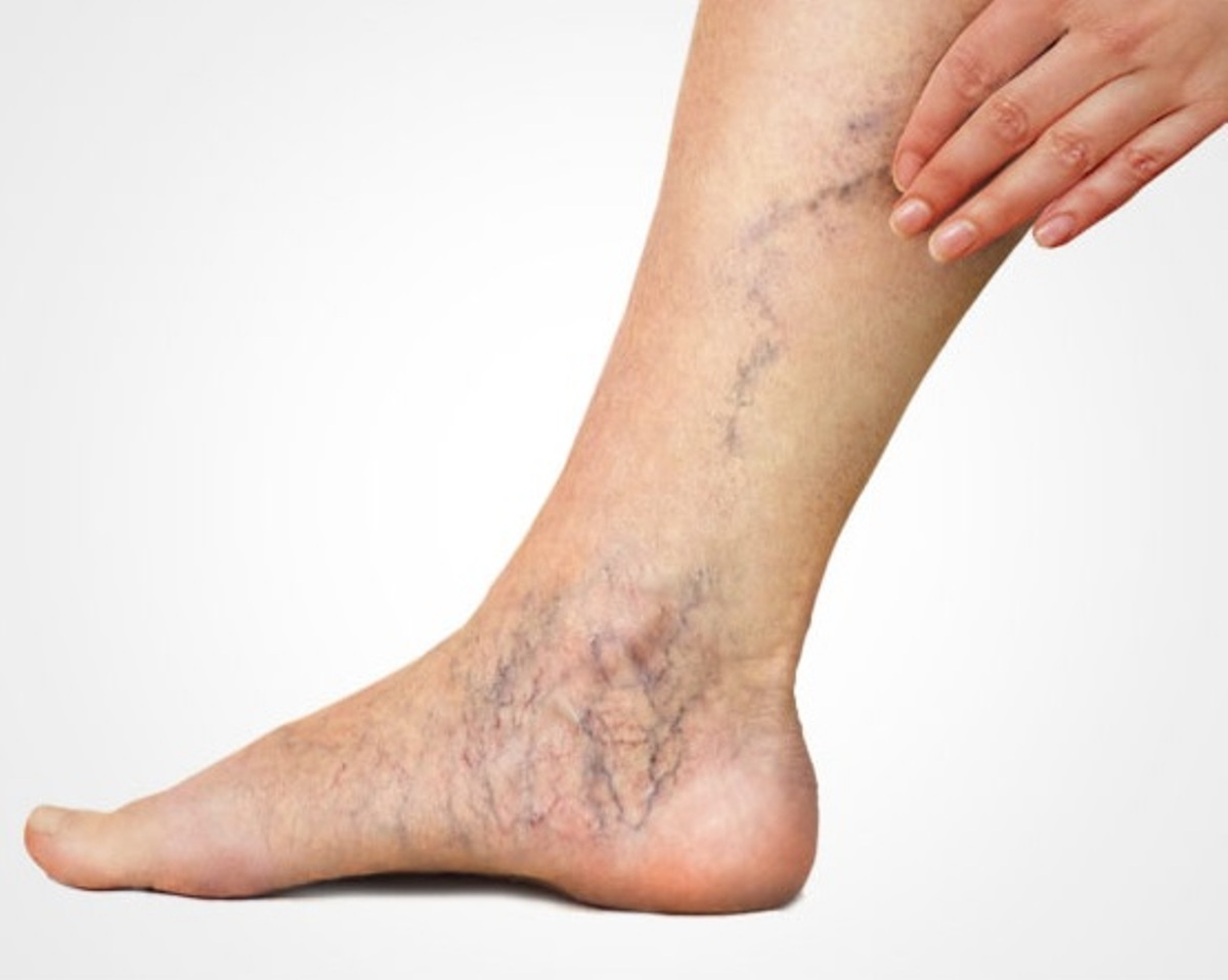 sclerotherapy-market